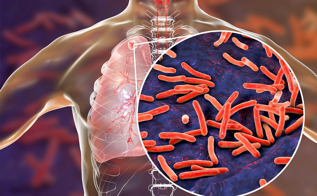 An illustration showing the human upper torso with a focus on the lungs. A magnified inset reveals a close-up view of Mycobacterium tuberculosis bacteria, depicted as red rod-shaped organisms against a dark background. The inset is overlaid on the left lung, indicating the site of TB infection. The overall image highlights the presence of TB bacteria in the respiratory system.